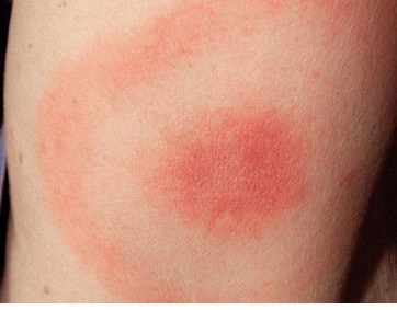 Bulls Eye Lyme Disease Rash